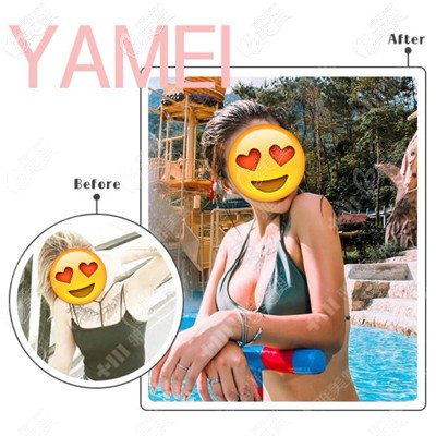 肖院长做自体脂肪隆胸案例