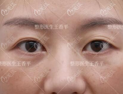 做刘志刚重睑术术前照 做刘志刚重睑术术前照