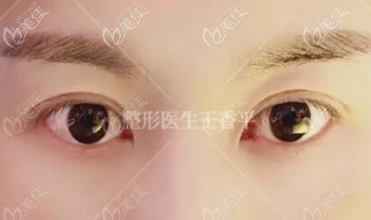 来看王香平给我做的平行型双眼皮，恢复好后效果自然无痕，超赞！