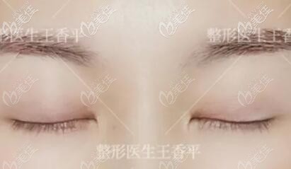 刘志刚重睑术术后恢复好闭眼效果照 刘志刚重睑术术后恢复好闭眼效果照