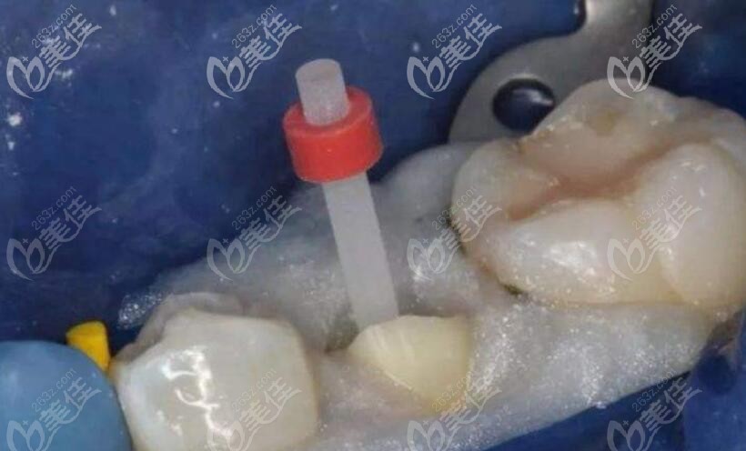 使用瓷桩修复牙齿的图