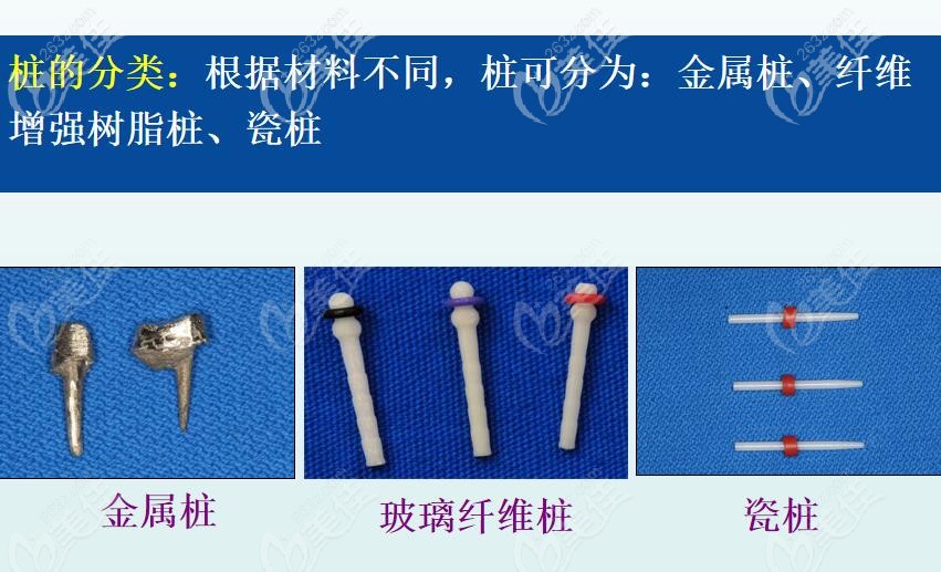 桩核冠材料之分