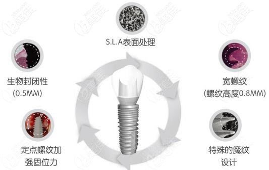 纽百特种植体的优势 纽百特种植体的优势