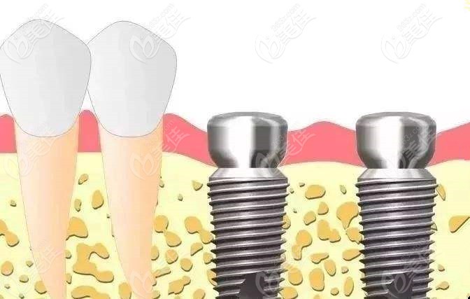 意大利BB种植体 意大利BB种植体