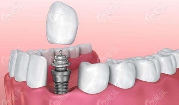 种植牙包括几个部位 种植牙包括几个部位