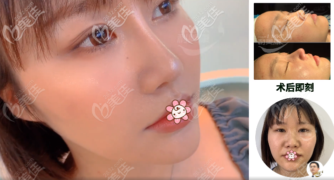 <!--<i data=20240703-sp></i>-->骆显红鼻综合案例 <!--<i data=20240703-sp></i>-->骆显红鼻综合案例