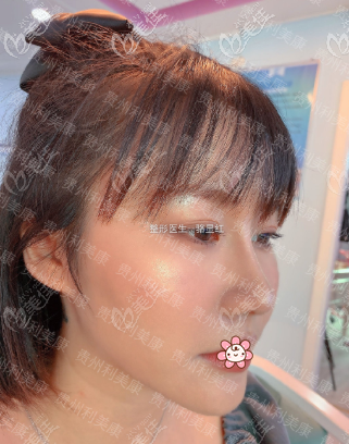 <!--<i data=20240703-sp></i>-->骆显红肋骨鼻术后1个月 <!--<i data=20240703-sp></i>-->骆显红肋骨鼻术后1个月