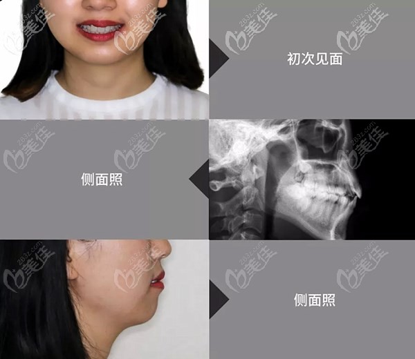 去北京牙管家做牵引术前的准备工作 去北京牙管家做牵引术前的准备工作