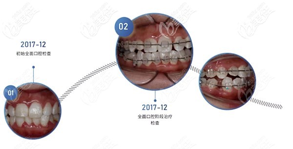 我做中线偏移用的陶瓷托槽矫正 我做中线偏移用的陶瓷托槽矫正