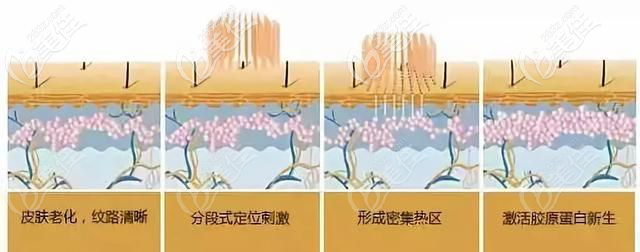 二氧化碳激光的治疗作用