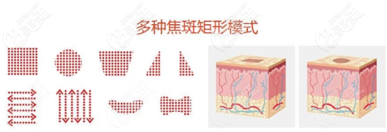 二氧化碳激光的治疗模式