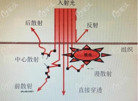 二氧化碳激光的治疗途径
