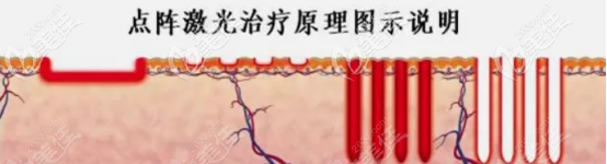 二氧化碳激光的治疗原理