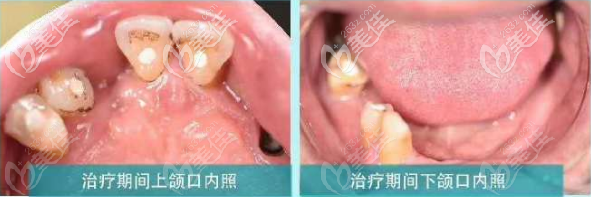 兰州牙王国数字化口腔全口磁性附着体义齿修复前 兰州牙王国数字化口腔全口磁性附着体义齿修复前