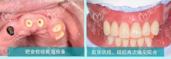 全口磁性附着体义齿打桩核并取模 全口磁性附着体义齿打桩核并取模