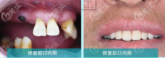 兰州牙王国数字化口腔,全口磁性附着体义齿修复案例:多颗牙缺失不一定非要种植牙!