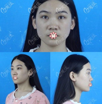 我原来的鼻子 我原来的鼻子