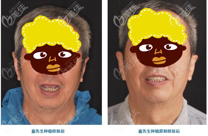 年过七旬的他饱受缺牙困扰，常州美奥用5颗诺贝尔cc做半口种植牙后，即刻就能咬甜瓜了