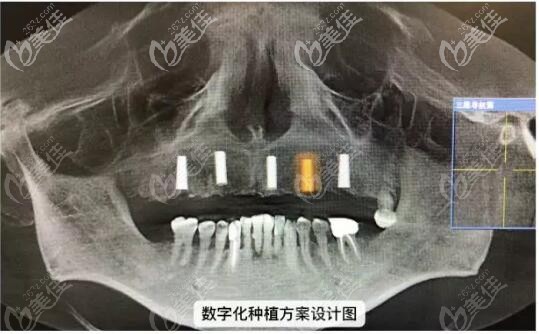 罗医生给秦先生设计的数字化种植方案设计图 罗医生给秦先生设计的数字化种植方案设计图