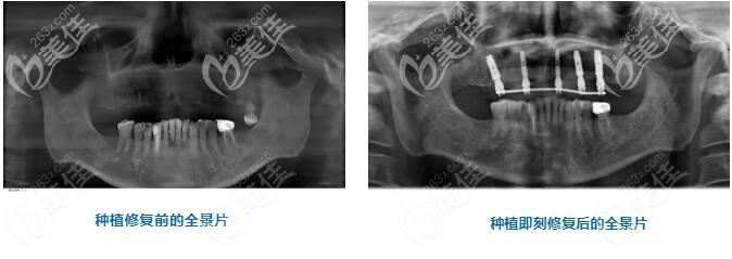 半口牙种植术后即刻全景片的对比 半口牙种植术后即刻全景片的对比