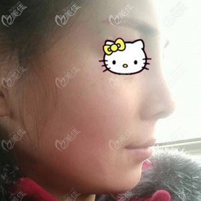 立秀加强型膨体隆鼻术后8天拆线