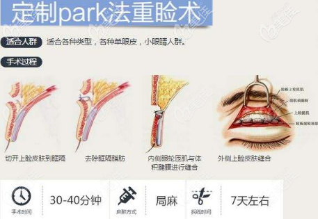 贵阳美莱陈劲PARK法双眼皮术 贵阳美莱陈劲PARK法双眼皮术