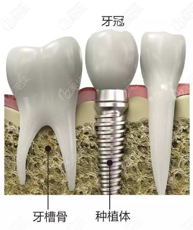 种植牙过程图解