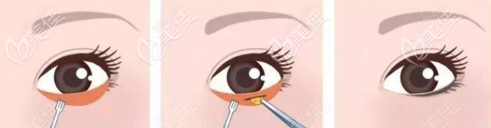 外切祛眼袋手术示意图