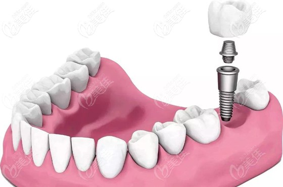 一颗种植牙的价格是多少钱