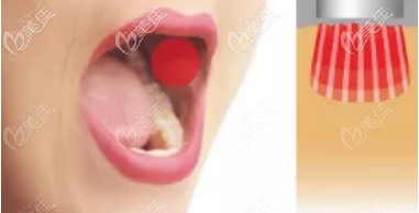 FOTONA 4D PRO具有Smooth无创粘膜收紧技术