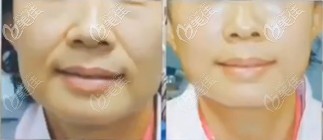 唐山苏亚美联臣做Fotona 4D pro效果对比