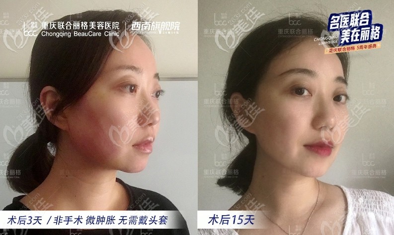 术后半个月左右