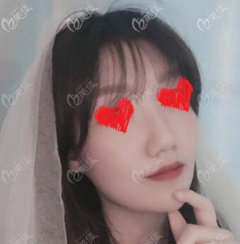 欧洲之星Fotona 4D一周恢复效果照