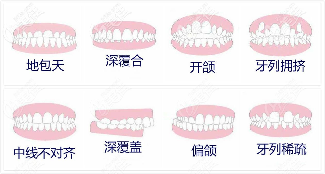 牙齿矫正适应症