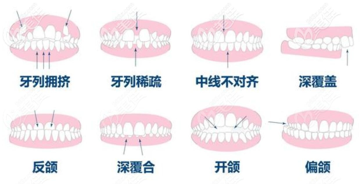 牙性和骨性偏颌示意图图片