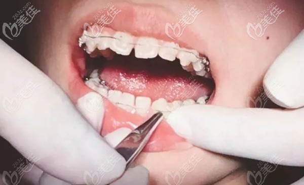 骨性加牙性龅牙