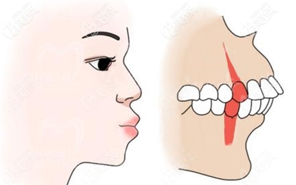 齿性凸嘴做正畸手术矫正