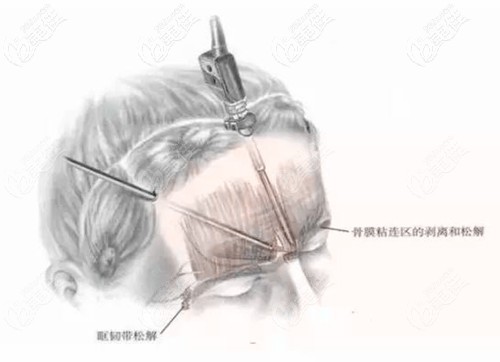 内窥镜额头除皱的优势 内窥镜额头除皱的优势
