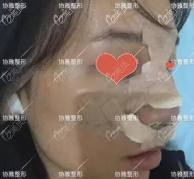鼻综合术后第1天效果照