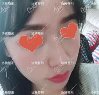 鼻综合拆完线效果照