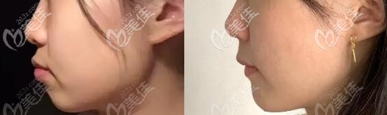 骨性龅牙矫正日记:在岳阳阳光口腔戴半隐形陶瓷牙套的日子...