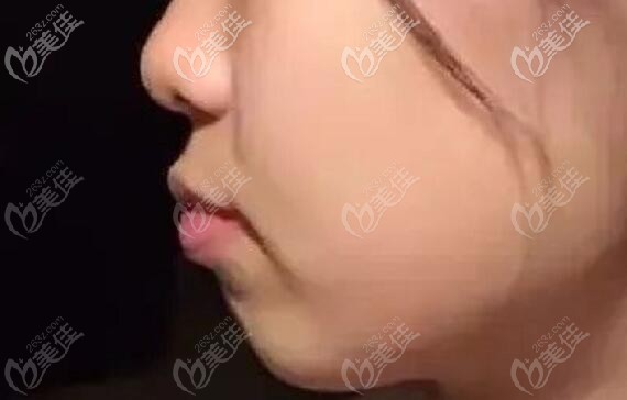 骨性龅牙矫正前的照片