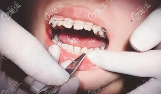 骨性龅牙戴半隐形陶瓷托槽的照片