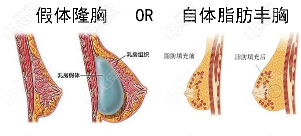 硅胶假体隆胸好还是自体脂肪丰胸好 硅胶假体隆胸好还是自体脂肪丰胸好