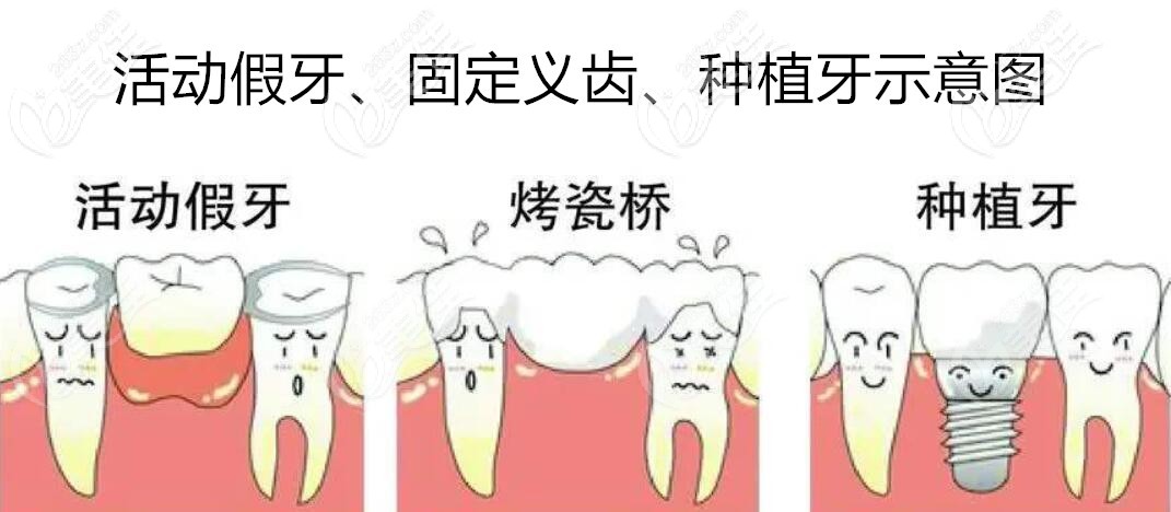 常见的牙齿缺失修复方法有哪些呢？  据黄复景院长介绍，常用修复缺牙