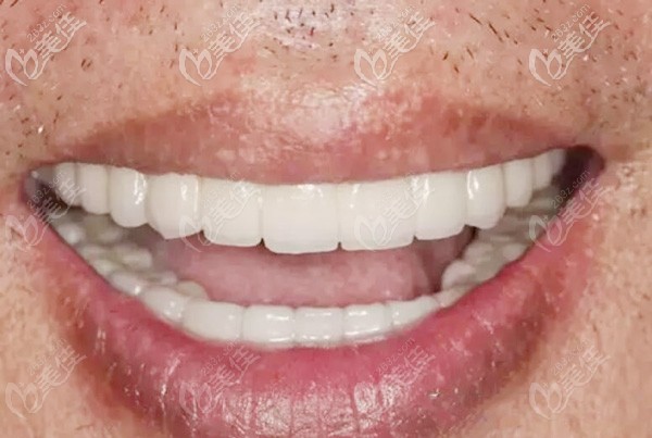 这是38岁男士做全口奥齿泰种植牙的图片，选的是北京劲松口腔的allon6技术