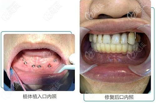 在郑州华西口腔做的Allon6种植牙后的效果