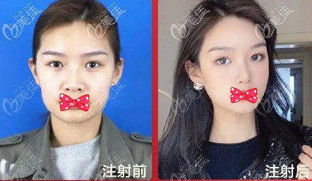 白鹏丽医生注射玻尿酸除皱案例