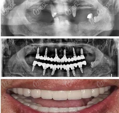 诺贝尔Speedy种植牙齿案例 诺贝尔Speedy种植牙齿案例