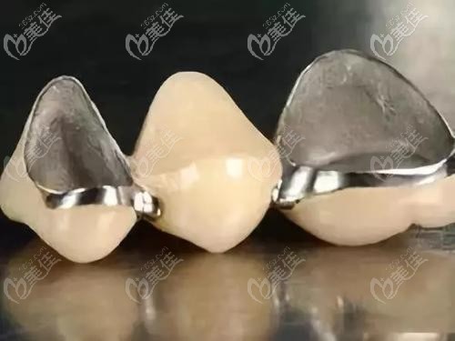 烤瓷牙的外观